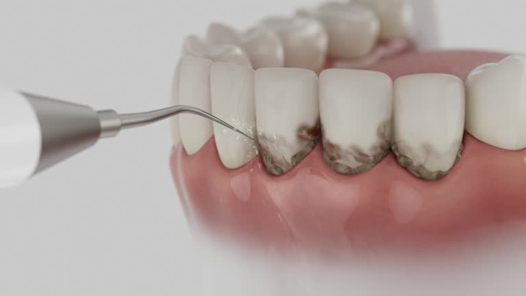 Trusted Dental Implants service in New Philadelphia, OH - Dentist Open Now